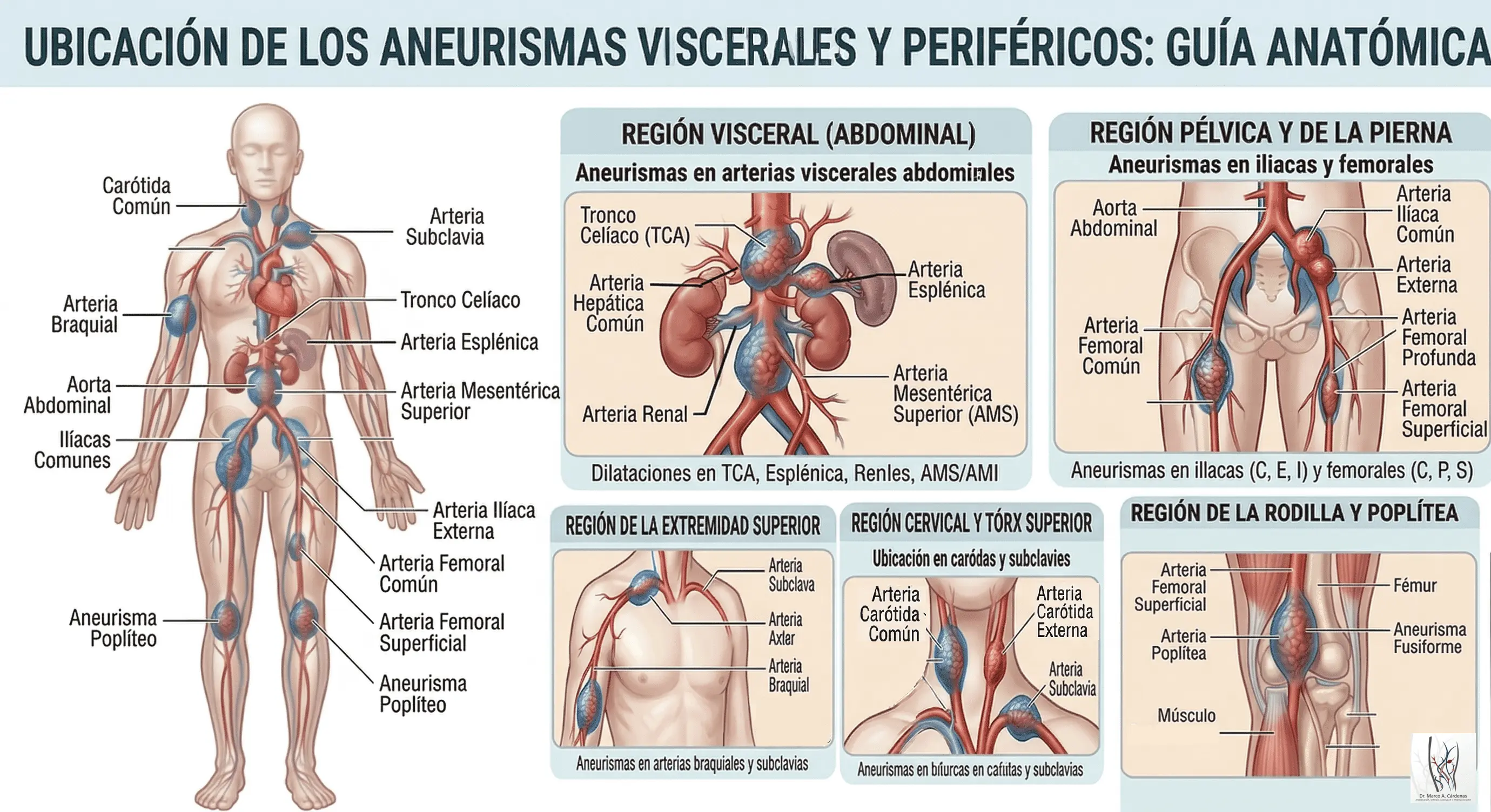 Aneurismas Viscerales